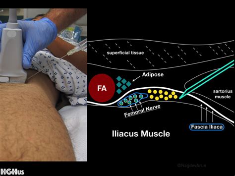 Infrainguinal Fascia Iliaca Plane Block Aka Femoral Nerve Block