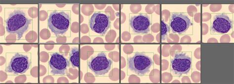 Hairy Cell Variant Leukemia