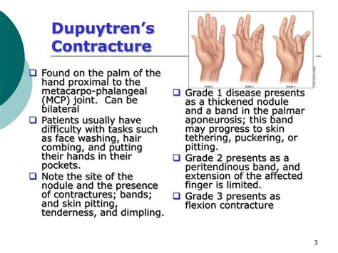 Ppt Dupuytrens Contracture Powerpoint Presentation Id543642