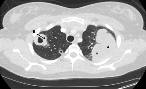 Ct Scan Revealed Revealed A Large Soft Tissue Mass In The Left Upper Download Scientific