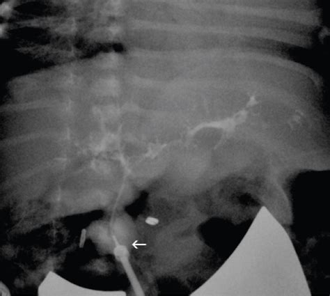 Clinmed International Library A Rare Case Of Biliary Atresia And Choledochal Cyst In A