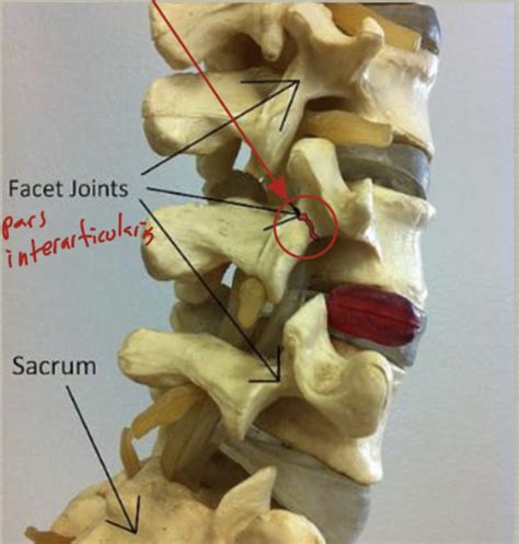 MSK 2 Lumbar Spine Pathologies Flashcards Quizlet