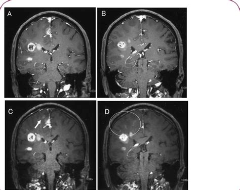 A D Images From A Year Old Male Diagnosed With Left Temporal