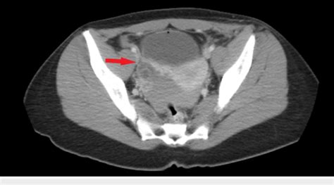 CT Scan Demonstrating Complex Cystic Mass Of The Right Adnexa Red