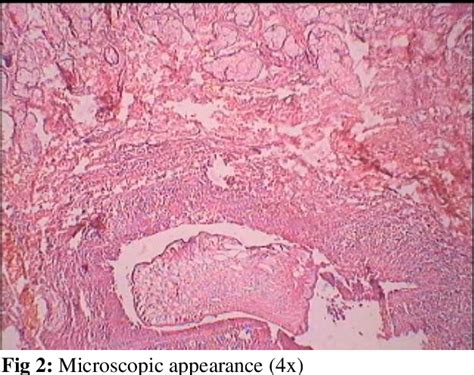 Figure 1 From Sparganosis A Rare Case Report Semantic Scholar