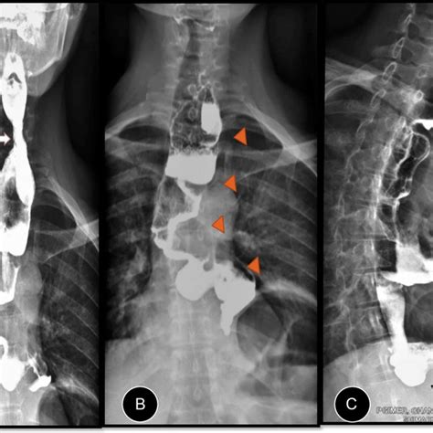 A Barium Swallow After Ileocolonic Transposition Shows Only Mild