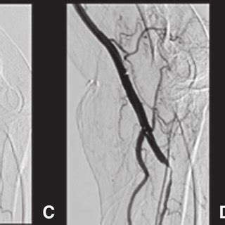 Endovascular Mechanical Thrombectomy Of Acute Radial Artery Occlusion