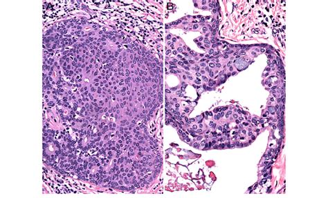 A Some Intraductal Proliferations In Sclerosing Polycystic Adenosis May