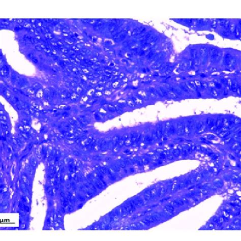 H Villoglandular Papillary Adenocarcinoma Exophytic Growth With Long