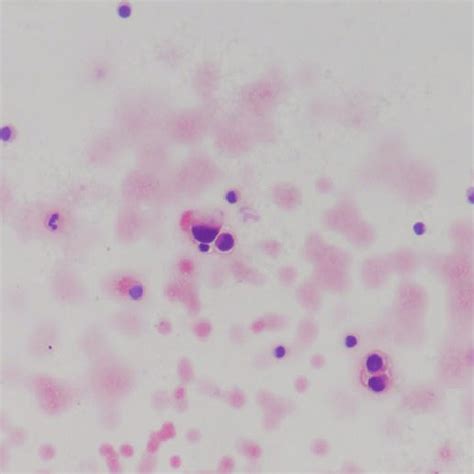 csf smear hematoxylin  eosin staining    baseline csf