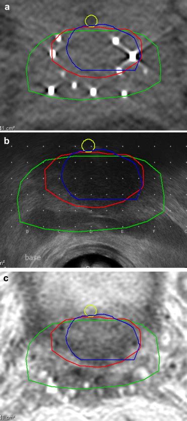 Transverse Images At The Base Showing Prostate Contours Transrectal