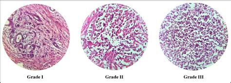 Histopathological Images Example Of Breast Cancer With Three Different