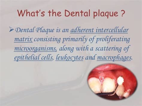 Dental plaque formation