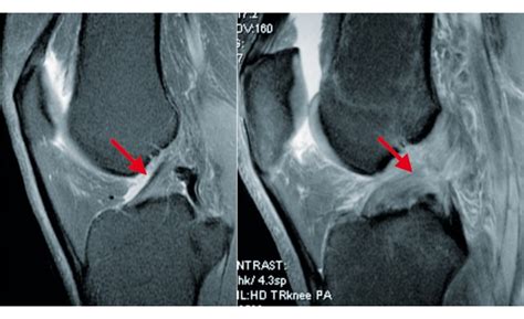 Ks Rupture Compl Te Du Ligament Crois Ant Rieur