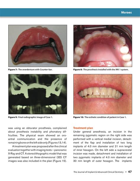 Integrating Implant Function and Esthetics - JIACD - Page 47 | Flip PDF
