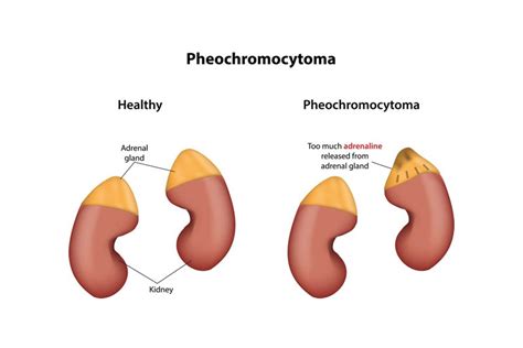 What Is A Pheochromocytoma Urology Specialist