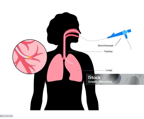 Bronchoscopy Procedure Concept Stock Illustration - Download Image Now ...