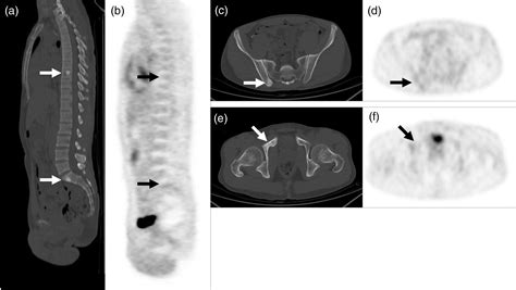 Skeletal Scintigraphy As An Important Complement For Detecting Bone