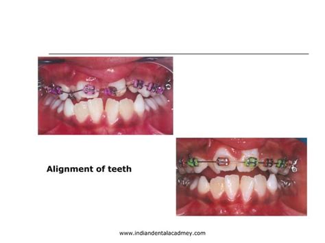 Alveolar Bone Grafting And Orthodontics Certified Fixed Orthodontic