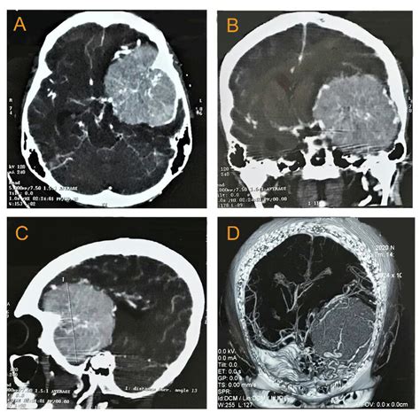 Imaging findings. (A-C) Contrast-enhanced head CT in axial, coronal and ...