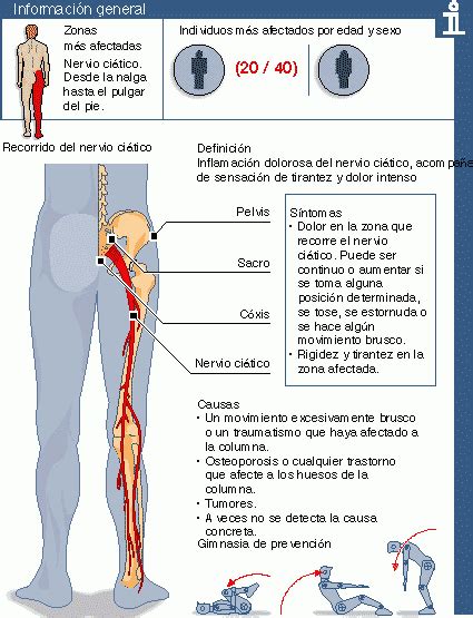 Qué Es La Ciática Y El Lumbago Y Cómo Puedes Tratarlo Healthy