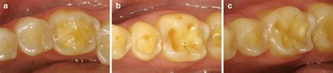 A C Typical Pattern Of Advanced Occlusal Erosion Of Teeth 45 And 46 Of