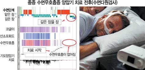 수면무호흡증 양압기 치료 치유 경험이 많은 의료진에게 솔까