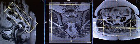 Mri Sacroiliac Joint Planning For Different Types Of Sacroiliac Joint