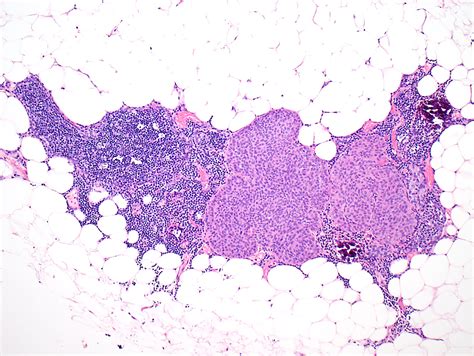 Pathology Outlines Thymoma