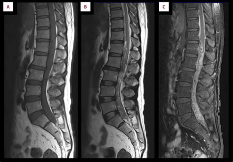 Lumbar Sagittal Magnetic Resonance Images T1wi A T2wi B And Download Scientific Diagram