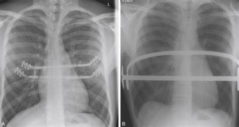 Chest Wall Reconstruction | Plastic Surgery Key