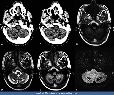 Cerebrotendinous Xanthomatosis Medlink Neurology