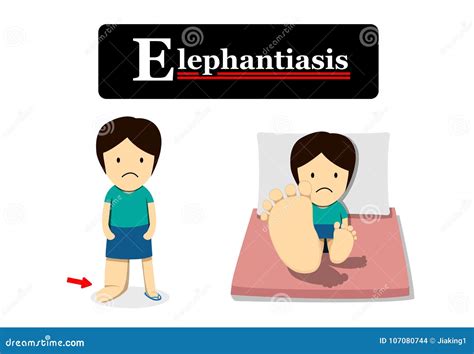 Leg Of A Person With Elephantiasis, Lymphatic Filariasis Stock ...