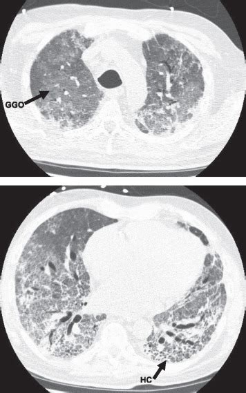 Acute Exacerbation Of Idiopathic Pulmonary Fibrosis Chest