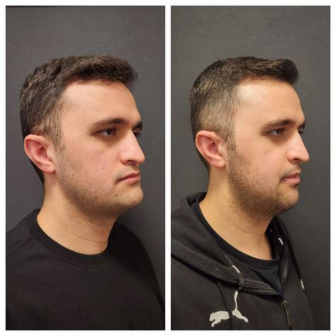 Before And After Jaw Surgery Before And After Photos At Exactly 1 Year