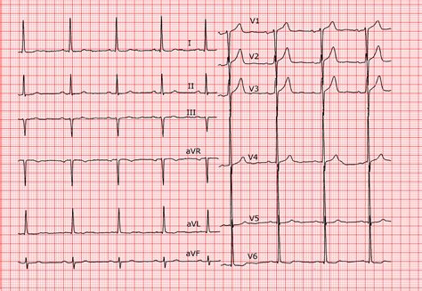 Cardio Fr Hypertrophie Ventriculaire Gauche