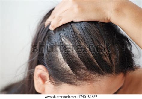 Closeup Thin Hair On Scalp Head Stock Photo Edit Now 1740184667