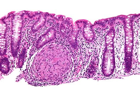 Crohn's disease - Libre Pathology