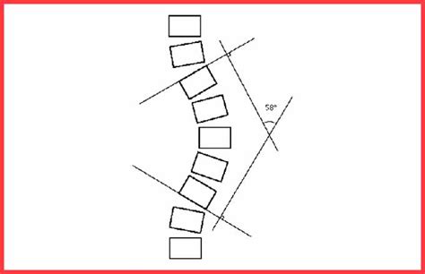 Scoliosis Braces Explained Types Effectiveness And Impact