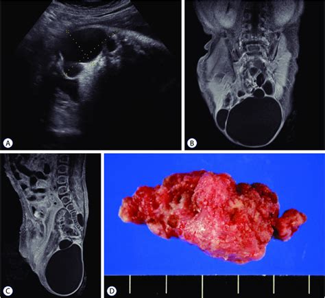 Sacrococcygeal Teratoma Of A Female Newborn A In Utero Download Scientific Diagram