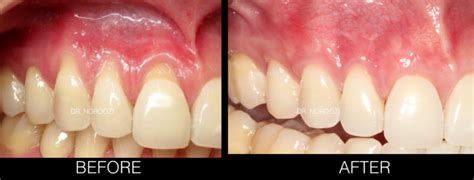 Teeth Sensitivity And Exposed Tooth Roots French Dental Services Dr