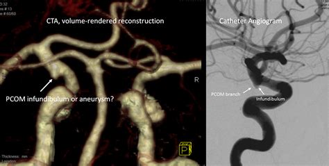 Infundibulum