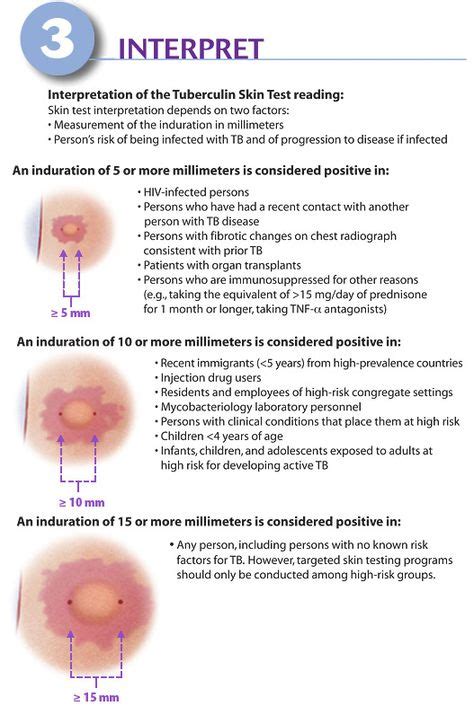 How To Interpret Mantoux Test Of Positive Tb Medicine Salud Y