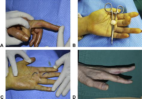 Comparative Study Of A1 Pulley Release And Ulnar Superficialis Slip