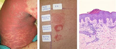 Acute Generalized Exanthematous Pustulosis To Acyclovir Lesions During