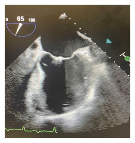 Tee Of Aortic Valve Vegetation 2 Download Scientific Diagram