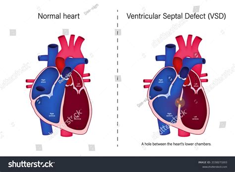 Atrial Ventricular Septal Defect