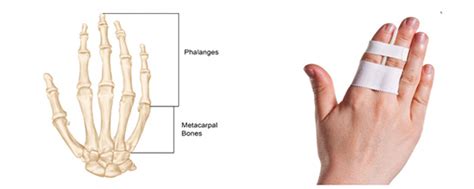 Broken Index Finger X Ray