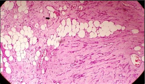 Figure 1 From Uterine Lipoleiomyoma A Rare Variant Of Benign Uterine