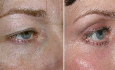 Eyelid Cancers – Treatment & Removal | Plastic Surgery Mumbai